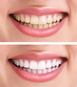 木更津氏清見台の歯科医院、清見台いしい歯科では、ご自宅でじっくり内側から歯を白くしていくことができる、ホームホワイトニングを取り扱っています。