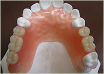 木更津市清見台の歯科医院、清見台いしい歯科では、お口の状態やライフスタイルに合わせて、保険の入れ歯から自費入れ歯まで幅広く対応し、装着感や安定性に配慮した入れ歯治療をご提案しています。