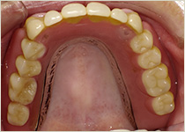 木更津市清見台の歯科医院、清見台いしい歯科では、お口の状態やライフスタイルに合わせて、保険の入れ歯から自費入れ歯まで幅広く対応し、装着感や安定性に配慮した入れ歯治療をご提案しています。