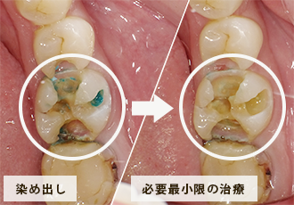 染め出し 必要最小限の治療