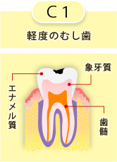 C1 軽度のむし歯