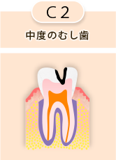 C2 中度のむし歯