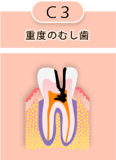 C3 重度のむし歯