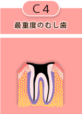 C4 最重度のむし歯