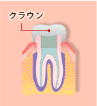 05.根管治療の流れ