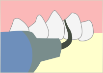 1.歯石の除去