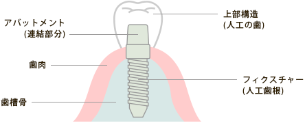インプラントの構造
