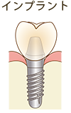 インプラント